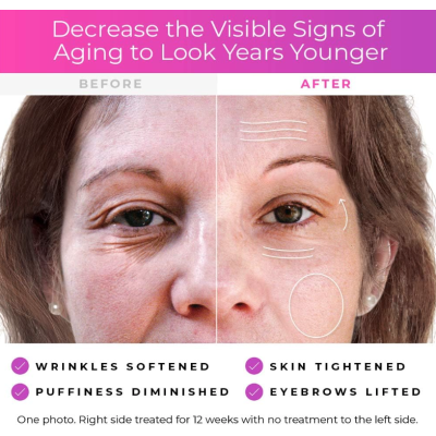 Derma Wand aparat de masaj anti îmbatranire pentru fata