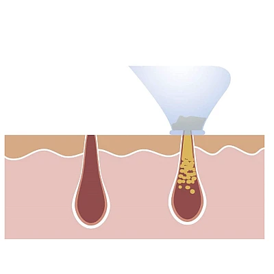 Aparat facial Derma Suction Curatitor ten cu vacum Aparat facial Derma Suction Curatitor ten cu vacum