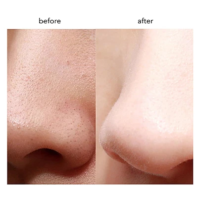 Aparat de curatare faciala 8815 pentru puncte negre Aparat de curatare faciala 8815 pentru puncte negre